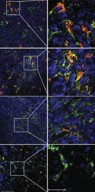 Microscopic images show the macrophage immune cells (the colorful splotches) proliferating and working in cancerous cells. (Image: Jin Hai Zheng et al., 2017)